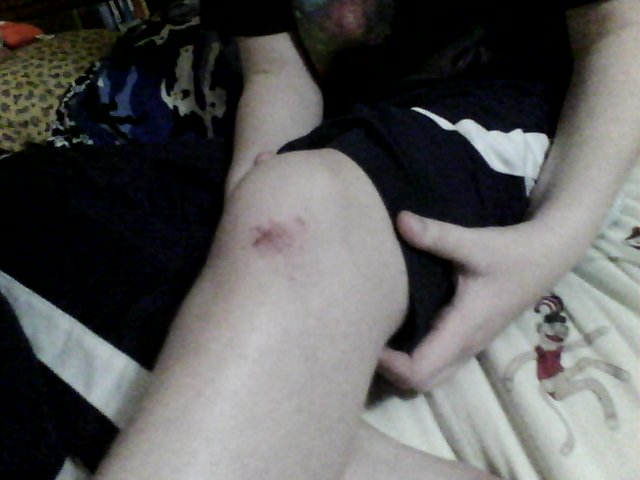 Extra blood flow to injured knee visible