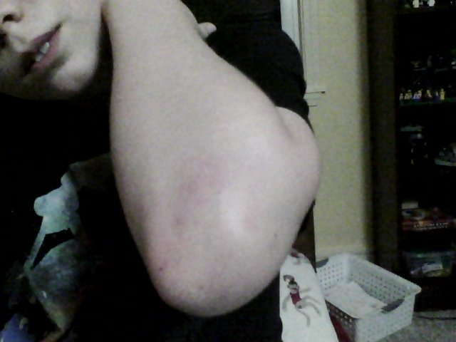 Extra blood flow to scraped elbow visible